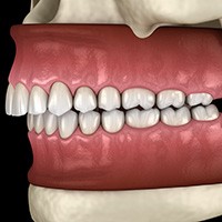 Digital image of an overbite