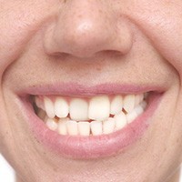 Up-close view of a crossbite