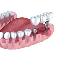 Implant bridge in Sycamore