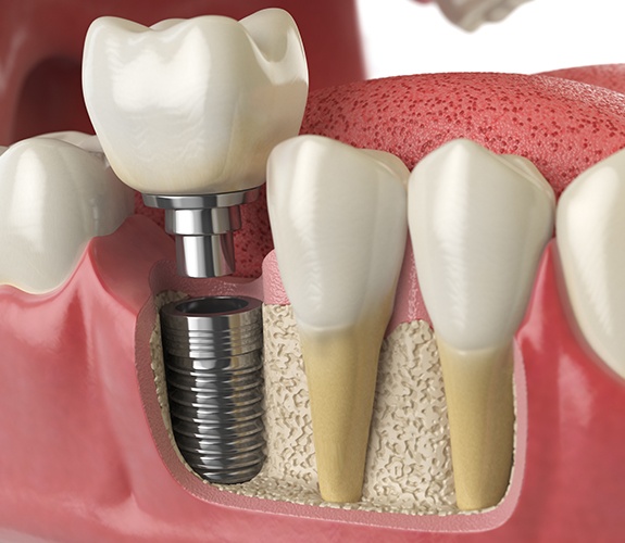 Animate dental implant replacement tooth placement