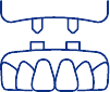 Animated dental implant supported denture placement