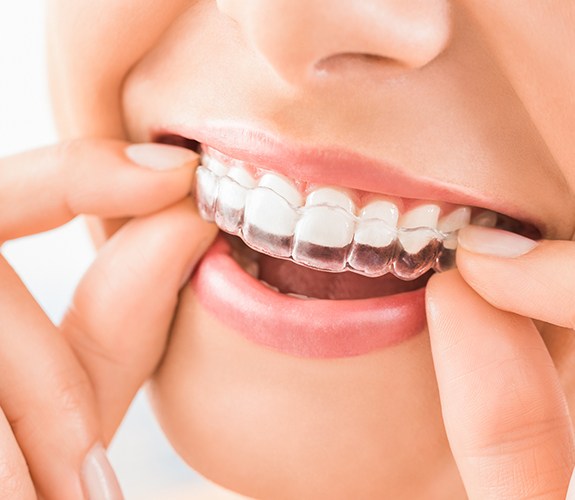 Patient placing an Invisalign tray