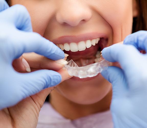 Closeup of patient placing an Invisalign tray