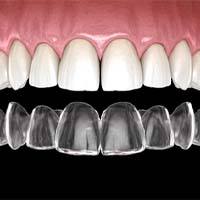 Illustration of aligner for Clear Aligners in Sycamore, IL being placed on upper arch