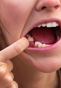 Woman with a missing tooth