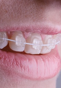 Patient inserting a clear aligner tray