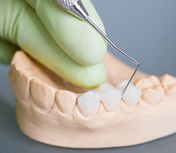 Model smile with dental bridge tooth replacement