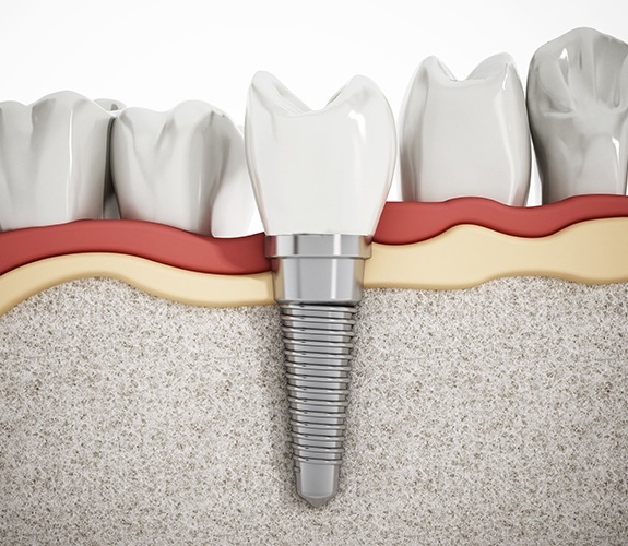 Animated dental implant supported replacement tooth