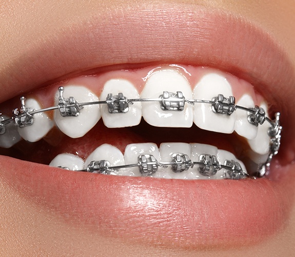 Closeup ofsmile with metal braces