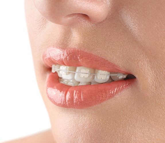 Closeup of smile with tooth colored braces