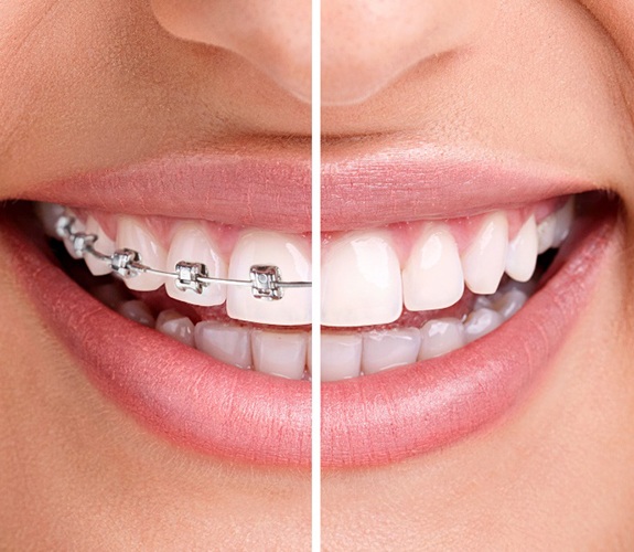 Closeup of before and after orthodontics in Sycamore, IL