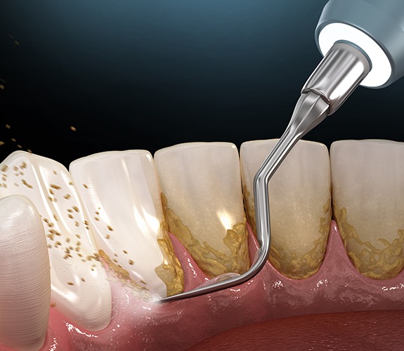 Animated smile during advanced periodontal procedure