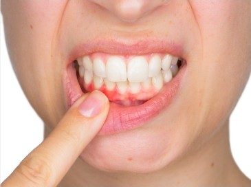 person pointing to bleeding gums