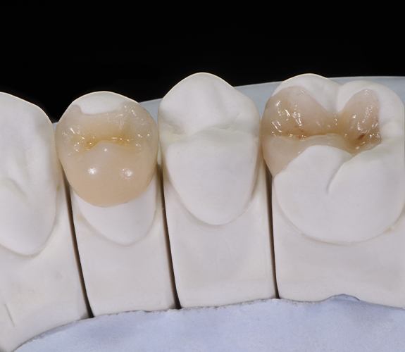 Model smile with porcelain inlays and onlays