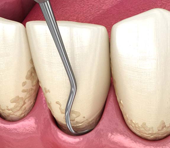 Close-up illustration of dental instrument being used during gum disease treatment