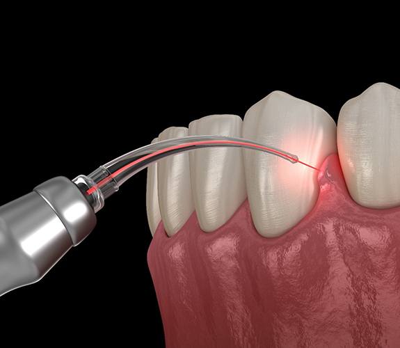 Digital illustration of soft tissue laser dentistry in Sycamore 