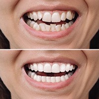 Before and after image of patient with veneers