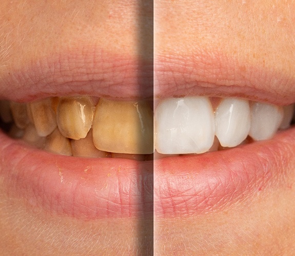 Up-close image of a person’s stained teeth before and after