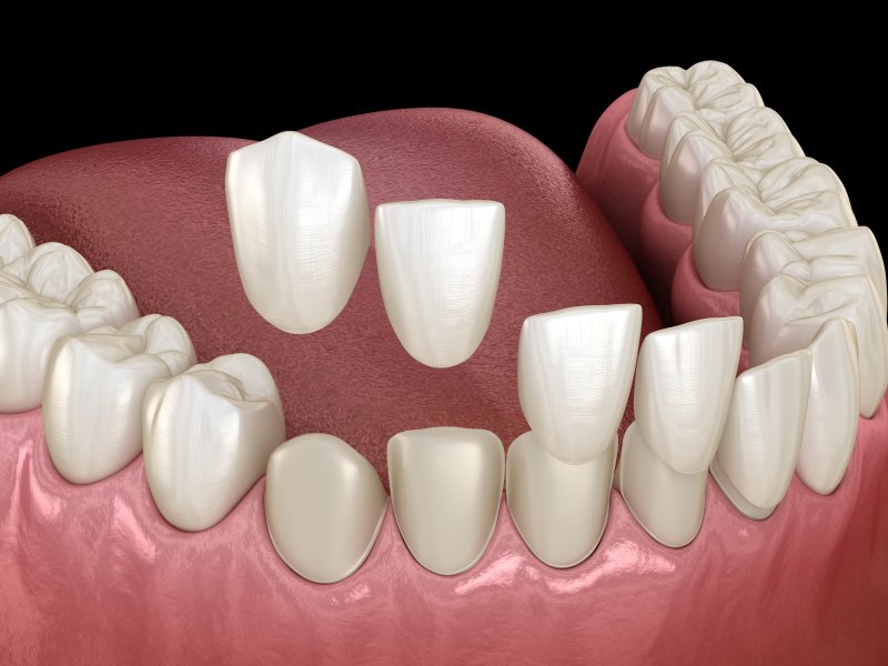 digital image of veneers